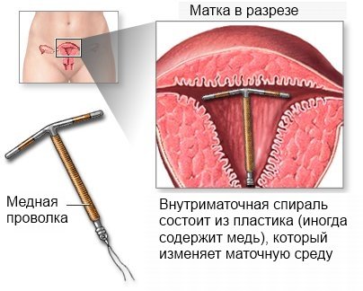 Contraception Device